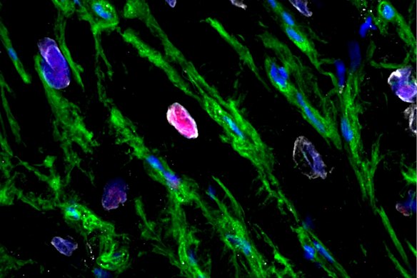An image showing a cardiomyocyte regenerating. The pink is where antibodies added to the tissue sample by the researchers have clung to proteins that are expressed during mitosis. 
