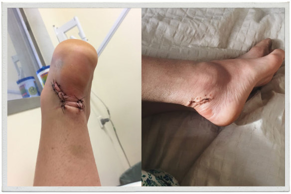 The wound to Steph Gould's heel after surgery to remove bits of stingray barb.