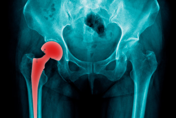 The NSW surgical taskforce wants same-day joint replacement surgery more readily available across the state. 