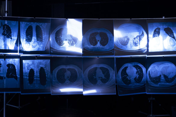 what-is-silicosis-is-it-the-new-asbestosis
