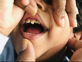 Tharunicaa's rotting teeth before her surgery. 