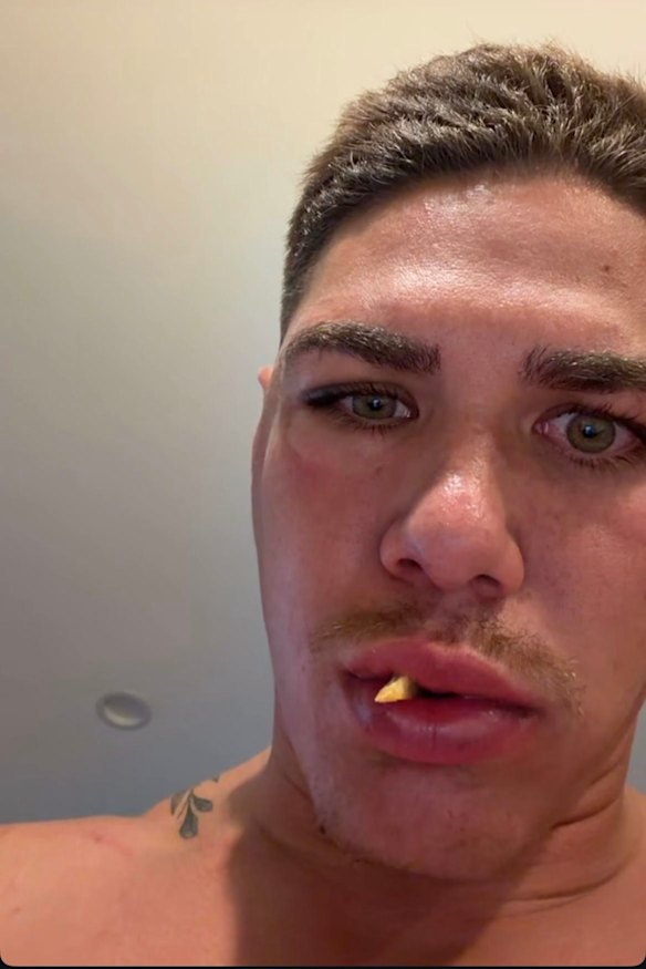 Reece Walsh posted a photo of his fractured cheekbone on Instagram.