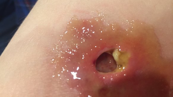 Madeleine Danaher's ulcer.