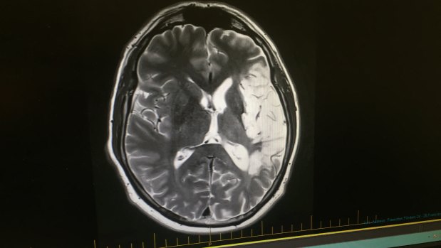 A scan of Anthony Coates' brain showing the damaged sections in white.