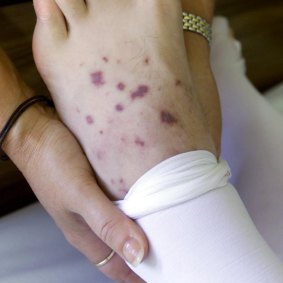 A meningococcal rash.