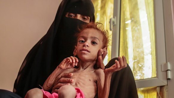 A woman holds her malnourished son in Hajjah, Yemen last month.