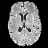 MRI brain scans showing 10 different dementia types.