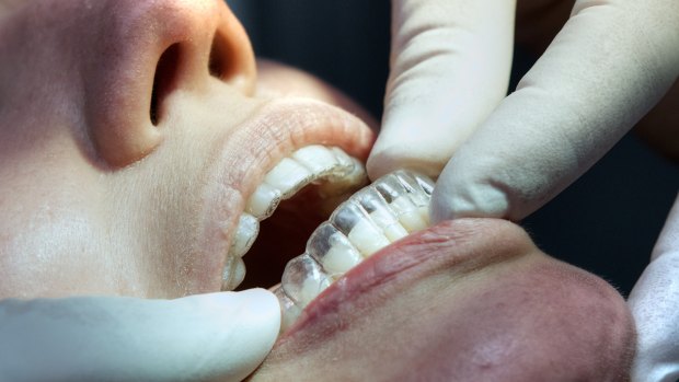Invisalign clear teeth aligners being fitted on a patient.