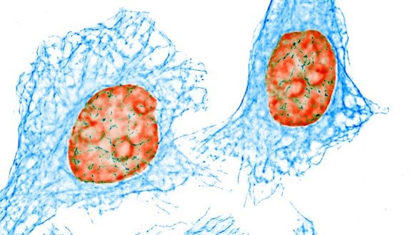 Lung cancer is a catch-all term for a range of cancers, not all of them caused by smoking.