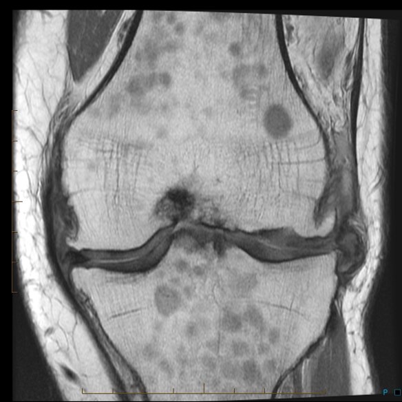 The scan of the author’s knee showing “odd” bone marrow. The dark area in the middle is the wreckage of a 30-year-old ACL reconstruction; the larger, paler spots indicate myeloma infiltration.