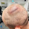 Dylan Edwards required 10 stitches to his head.