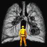 silicosis