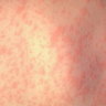 Two measles cases in Brisbane and Logan spark warnings