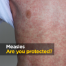Travelling soon? Health authorities urge you to get a measles vaccine
