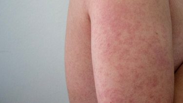 Measles can be easily spread from person to person.
