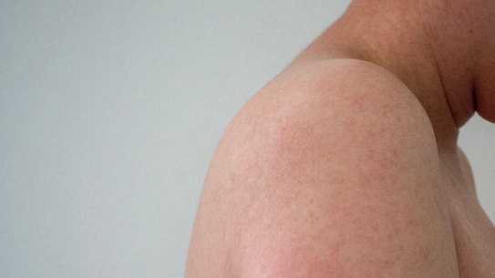 Measles is highly contagious.