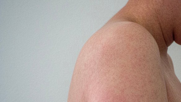 Metro Health South has seen a rise of measles from about three cases per year to seeing eight cases in the last few weeks.