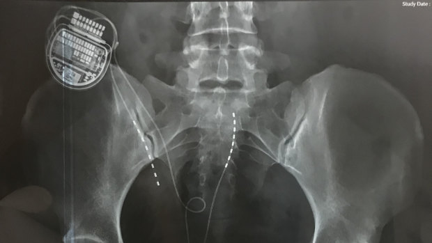 An x-ray showing a spinal cord stimulator in situ.