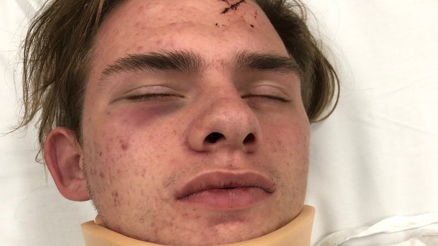 Autistic teen Jayden D'Abaco after he was attacked on Saturday night