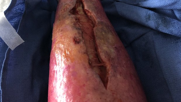 The flesh-eating disease ate away most of Tom’s lower leg.