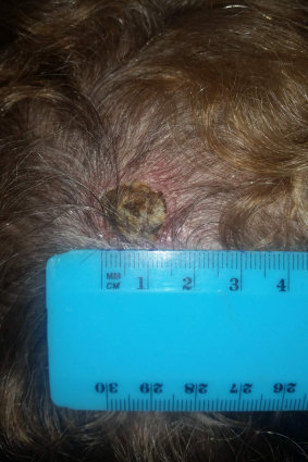 Susan Cohen's scalp following the application of black salve.