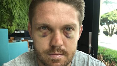 Friendly fire: Chris Lawrence after his training mishap.