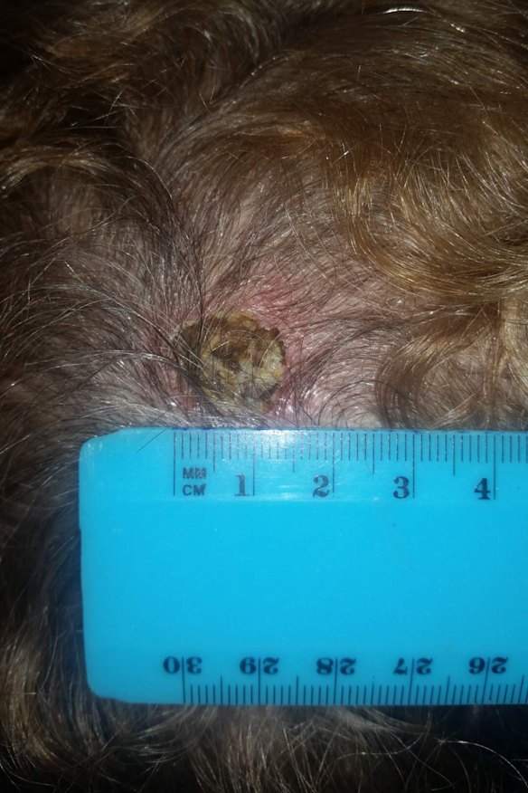 Susan Cohen's scalp following the application of black salve.
