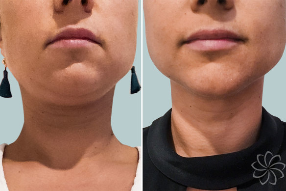 Before and after images promoting Ulfit treatments on the chin and neck.