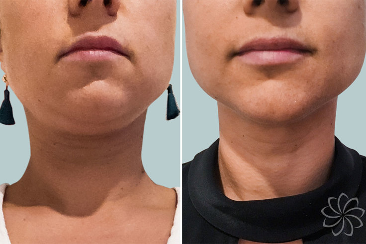 Is The Lunchtime Facelift Really Any Good