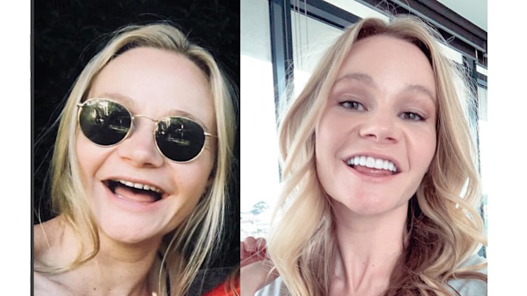 The Lifelong Cost Of The Selfie Smile Optional Dental Veneers