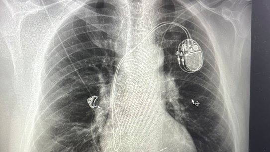 An X-ray of Fotis Kapetopoulos’ chest after he had a pacemaker installed.