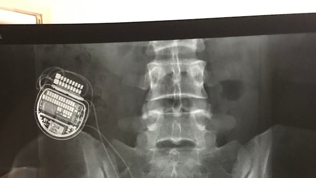An X-ray showing a spinal cord stimulator implanted in a patient.