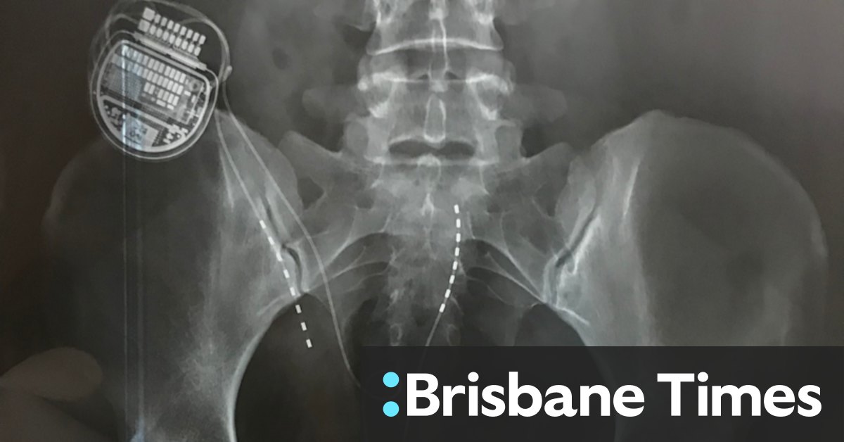 Scientists slam pain report funded by Neuromodulation Society of Australia and New Zealand which is linked to makers of spinal cord stimulators - Vimarsana News