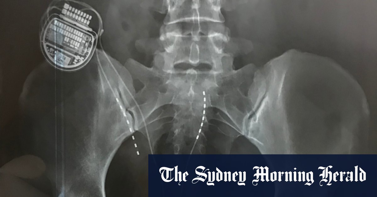 Scientists slam pain report funded by Neuromodulation Society of Australia and New Zealand which is linked to makers of spinal cord stimulators - Vimarsana News