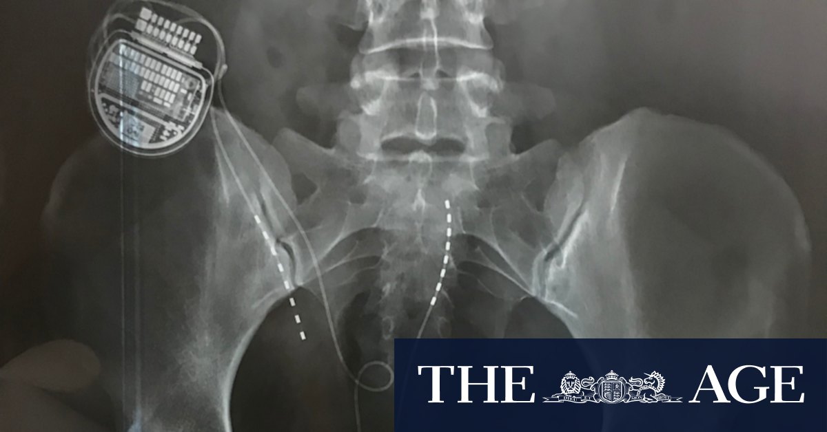 Scientists slam pain report funded by Neuromodulation Society of Australia and New Zealand which is linked to makers of spinal cord stimulators - Vimarsana News