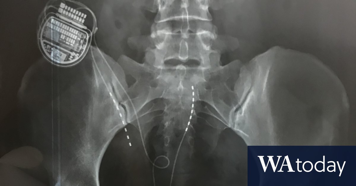 Scientists slam pain report funded by Neuromodulation Society of Australia and New Zealand which is linked to makers of spinal cord stimulators - Vimarsana News