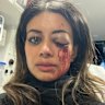 Hannah Thomas with a brusied and swollen eye, and bloodied face in an ambulance after police arrested her during a protest in Belmore on Friday 28 June, 2025. 