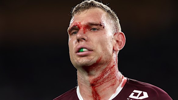 Injured Manly star Tom Trbojevic.