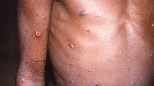 The right arm and torso of a patient, whose skin displayed a number of lesions due to what had been an active case of monkeypox.