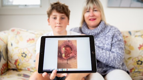Gus Charles and his mother Sally.  Gus was diagnosed with a Buruli ulcer in 2017. 