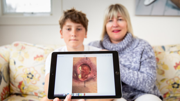 Gus Charles and his mother Sally.  Gus was diagnosed with a Buruli or Bairnsdale ulcer about 12 months ago.