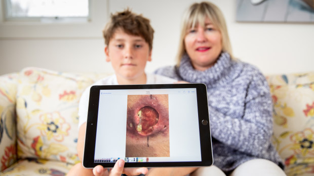 Gus Charles and his mother Sally.  Gus was diagnosed with a Buruli or Bairnsdale ulcer about 12 months ago.