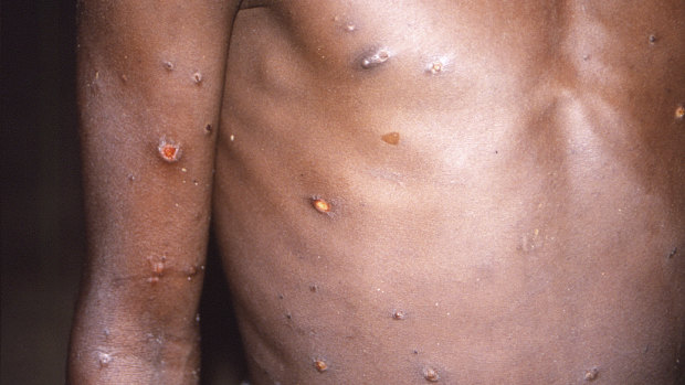 This 1997 image provided by CDC, shows the right arm and torso of a patient, whose skin displayed a number of lesions due to what had been an active case of monkeypox. 