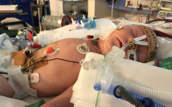 Baby Jasper hooked up to an ECMO machine which saved his life in May 2017 at Sydney Children's Hospital in Randwick.
