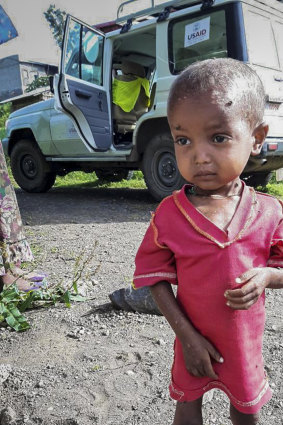 A severely malnourished child at the Ayder Referral Hospital in Mekele. 