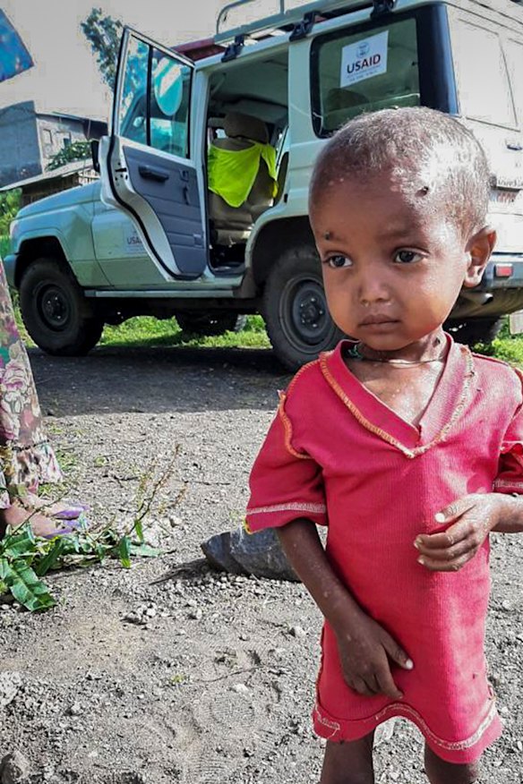 A severely malnourished child at the Ayder Referral Hospital in Mekele. 