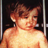 Measles will be back after 22 million babies miss their shots: WHO