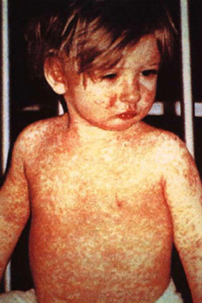 The highly infectious disease is especially dangerous for young children who haven't had the MMR vaccination.