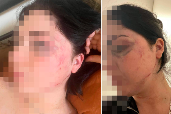 One victim provided photos showing the injuries she says she sustained after an alleged assault by another Swillhouse employee. 