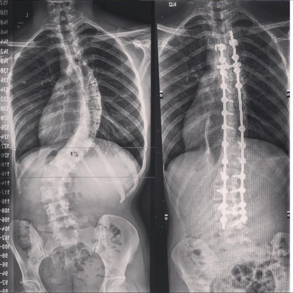 Ashwod's spine, pre- and post-surgery.
